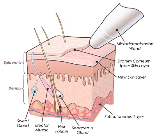 Microdermabrasion in Melbourne