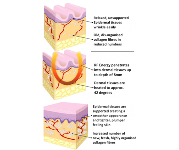 Radiofrequency Skin Tightening