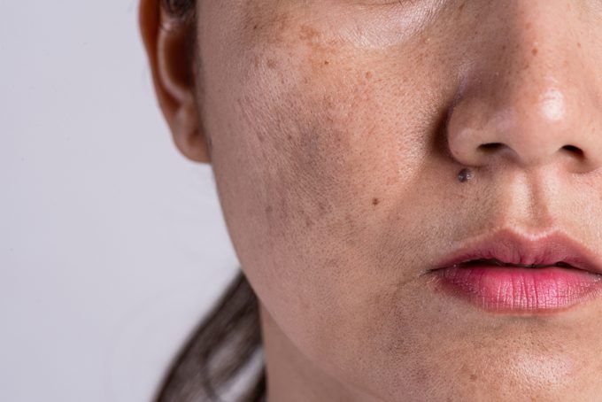 Pigmentation: Age Spots, Freckles, Melasma
