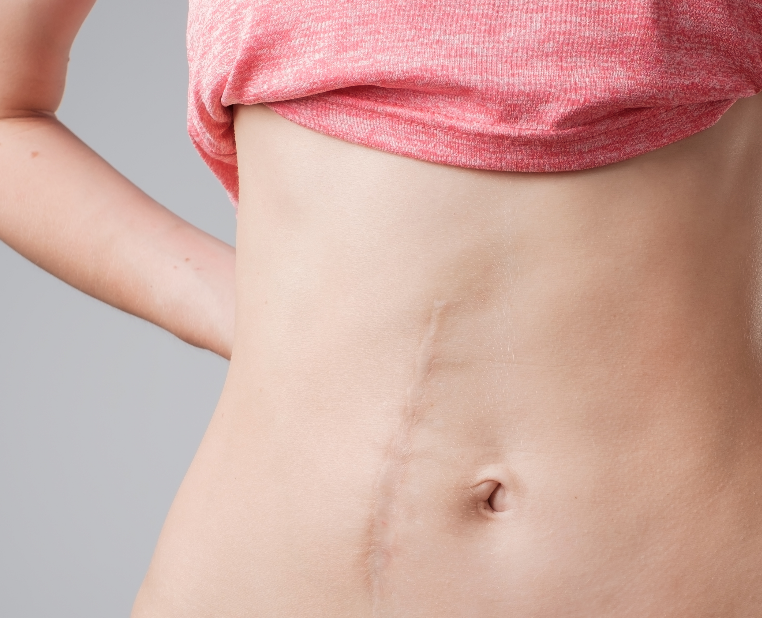 Scars and Keloids