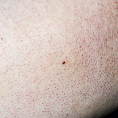 Hair Ingrown Unwanted Hirsutism Kp Bay Medical Aesthetics