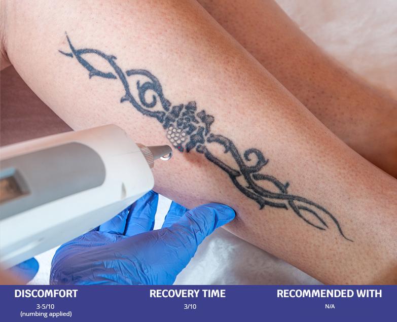 Laser Tattoo Removal