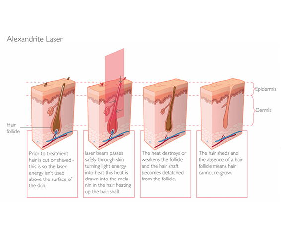 Laser Hair Removal Bay Medical Aesthetics
