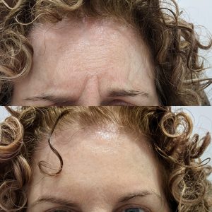 anti wrinkle injections bayside
