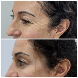 anti wrinkle treatment melbourne