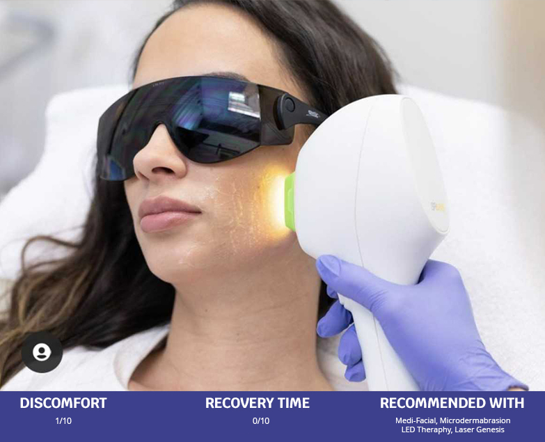 Radiofrequency Skin Tightening