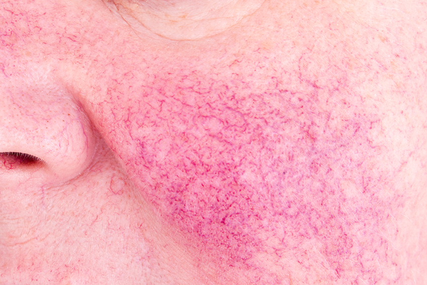 Redness, Rosacea & Broken Capillaries