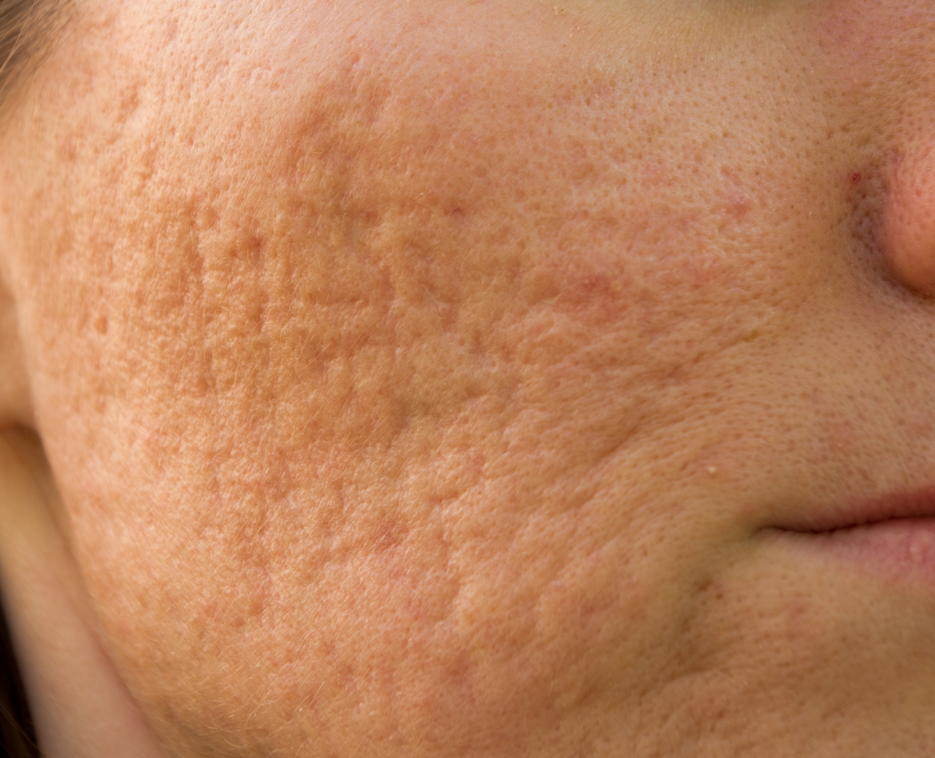 Scars, Keloids