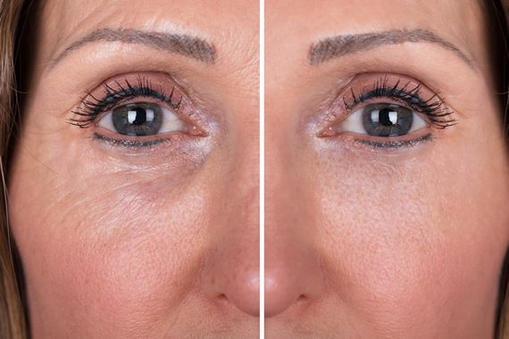 The Benefits of Using a Skin Booster for Under Eye Treatment