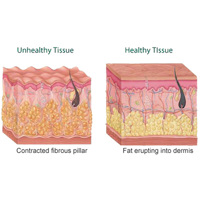 mesotherapy for cellulite
