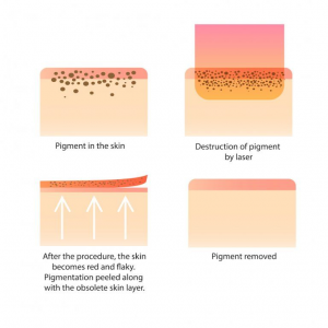 Pigmentation