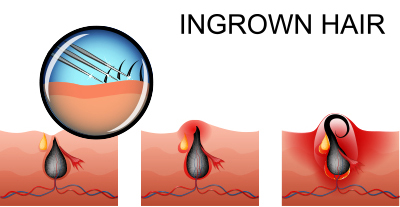 Ingrown Hair