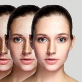 Pigmentation: Age Spots, Freckles, Melasma