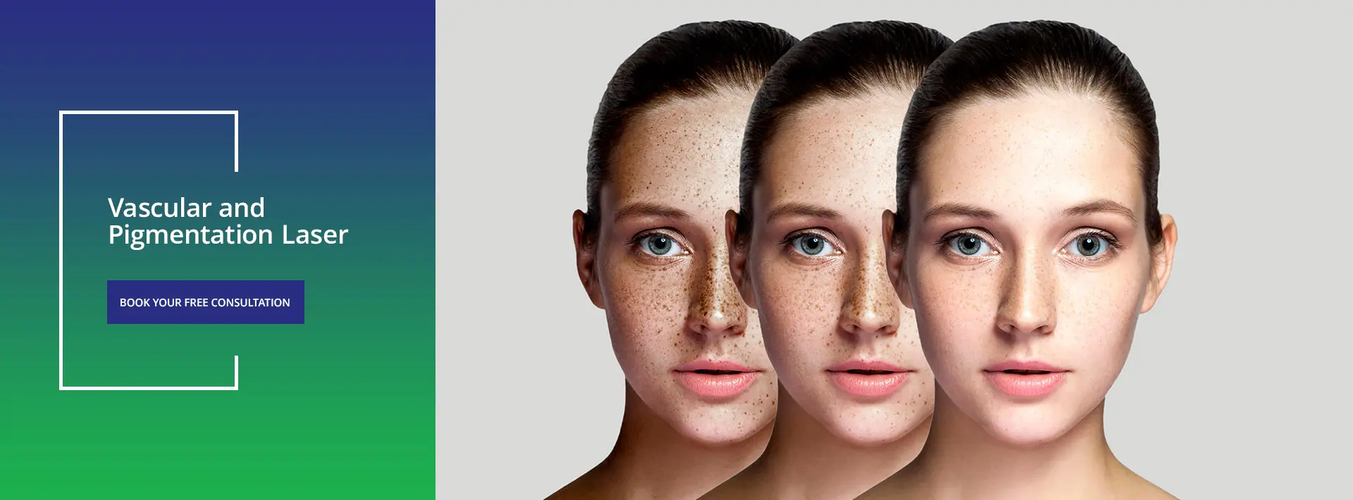 Pigmentation & Vascular Laser