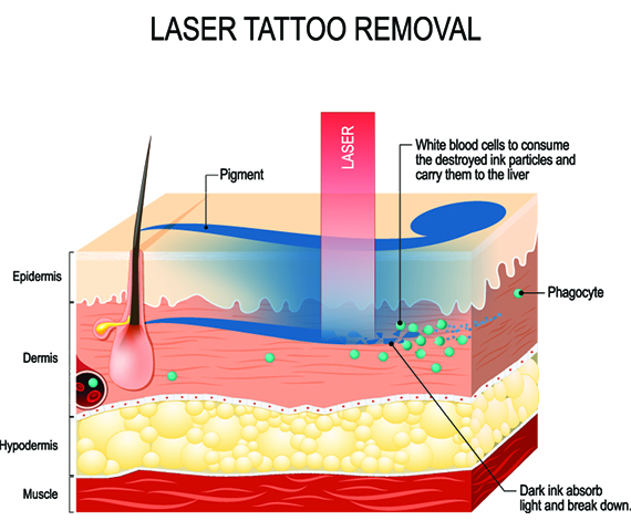 Laser Tattoo Removal