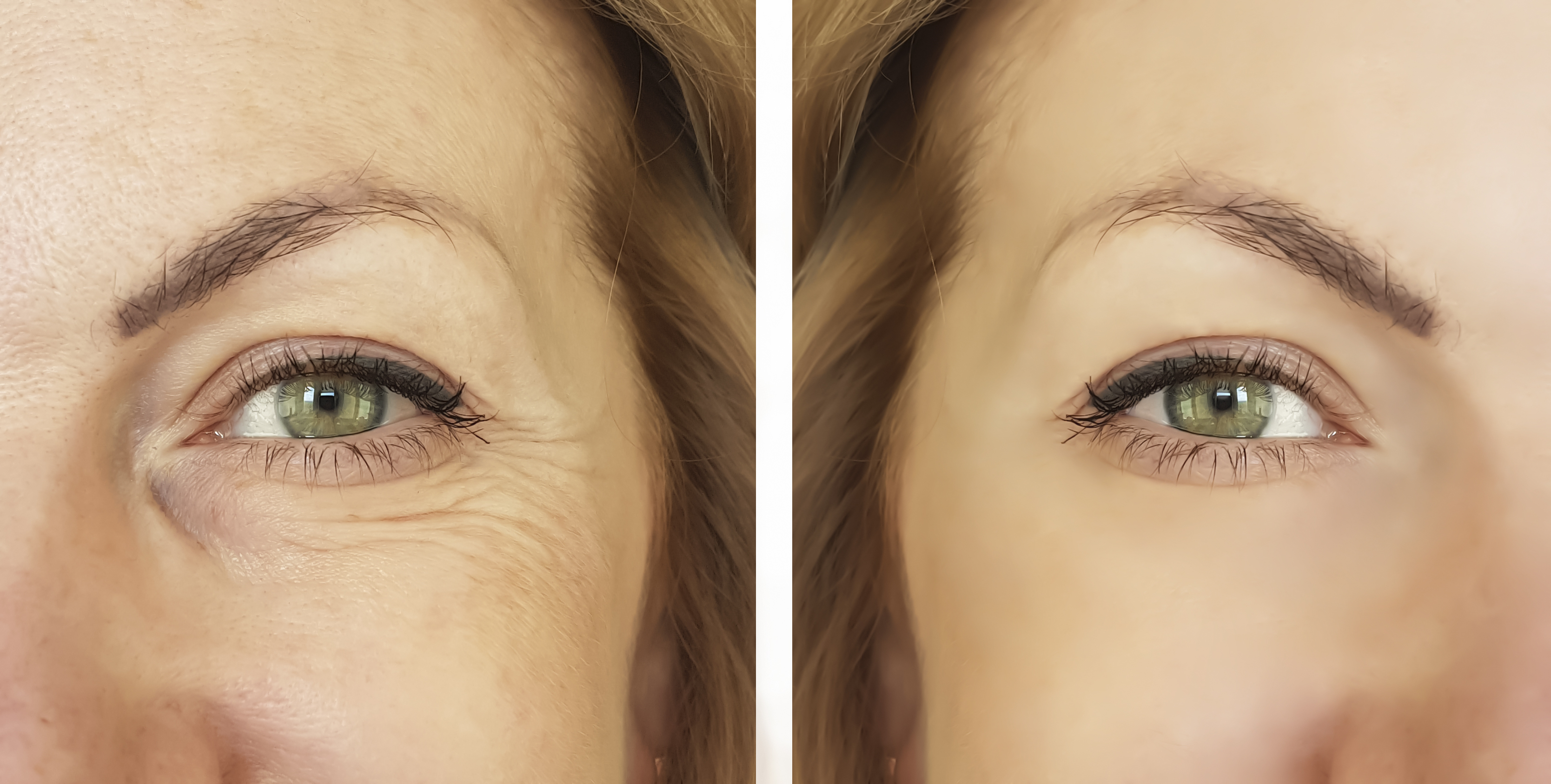 39 HQ Photos Cat Eye Lift Pdo Threads / Before and After Gallery Non