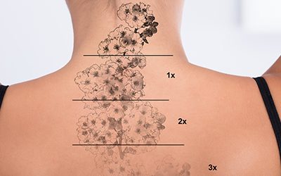 Remove Unwanted Tattoos With Laser Treatment Learn More