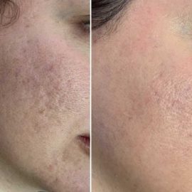 Scars, Keloids