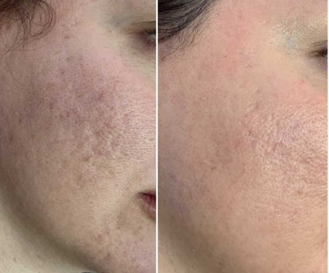 Subcision Scar Treatment in Melbourne | Bay Medical Aesthetics