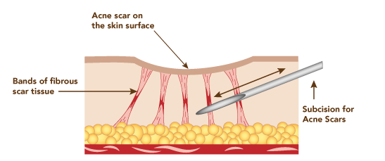 Subcision Scar Treatment in Melbourne