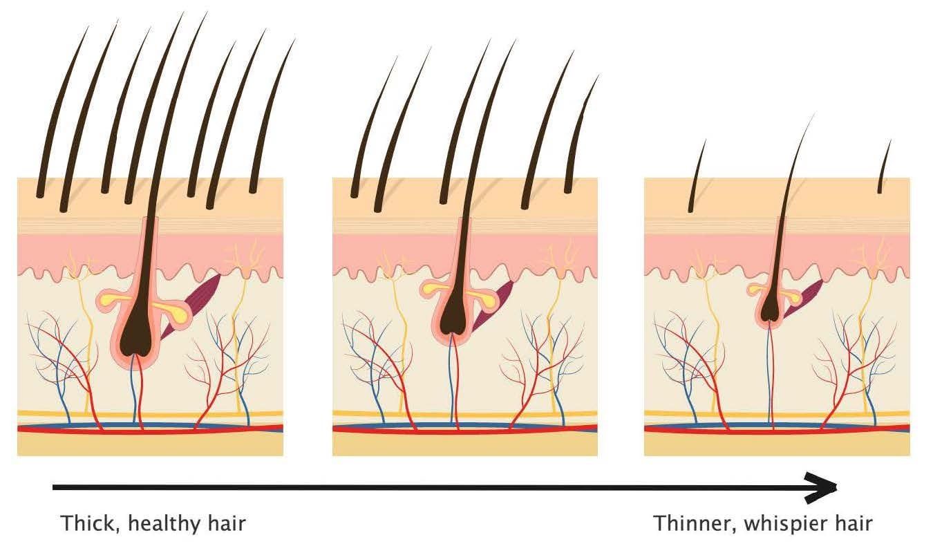 Hair Loss