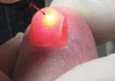 Fungal Infection of Nails