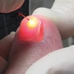 Fungal Infection of Nails