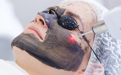 6 Benefits Of Carbon Laser Treatment