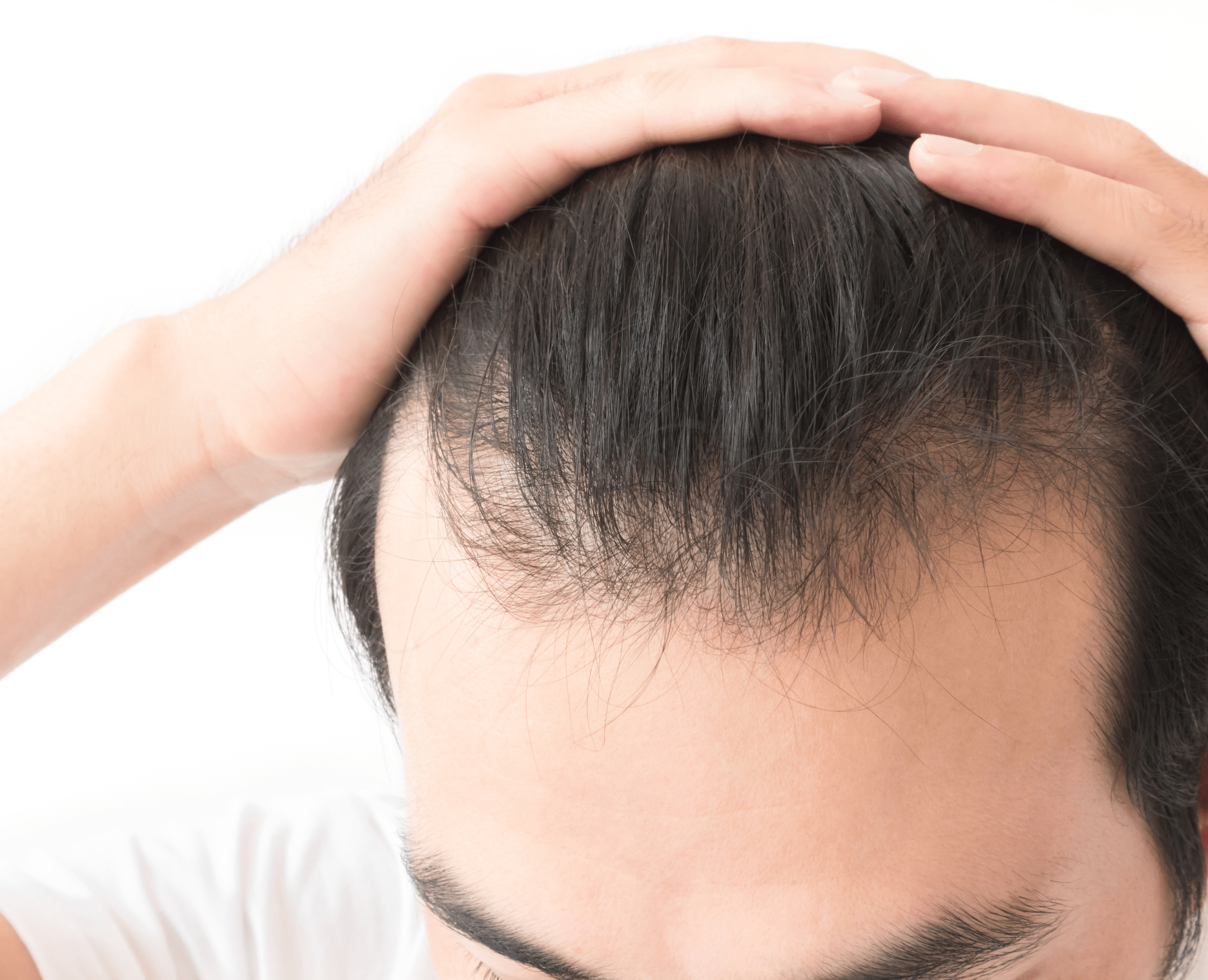 Hair Loss Treatment in Melbourne | Bay Medical Aesthetics