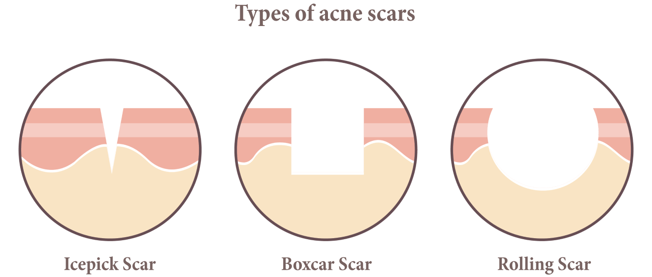 Scars & Stretch Marks Removal Melbourne