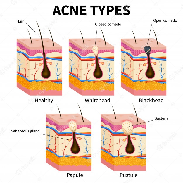 acne treatment melbourne