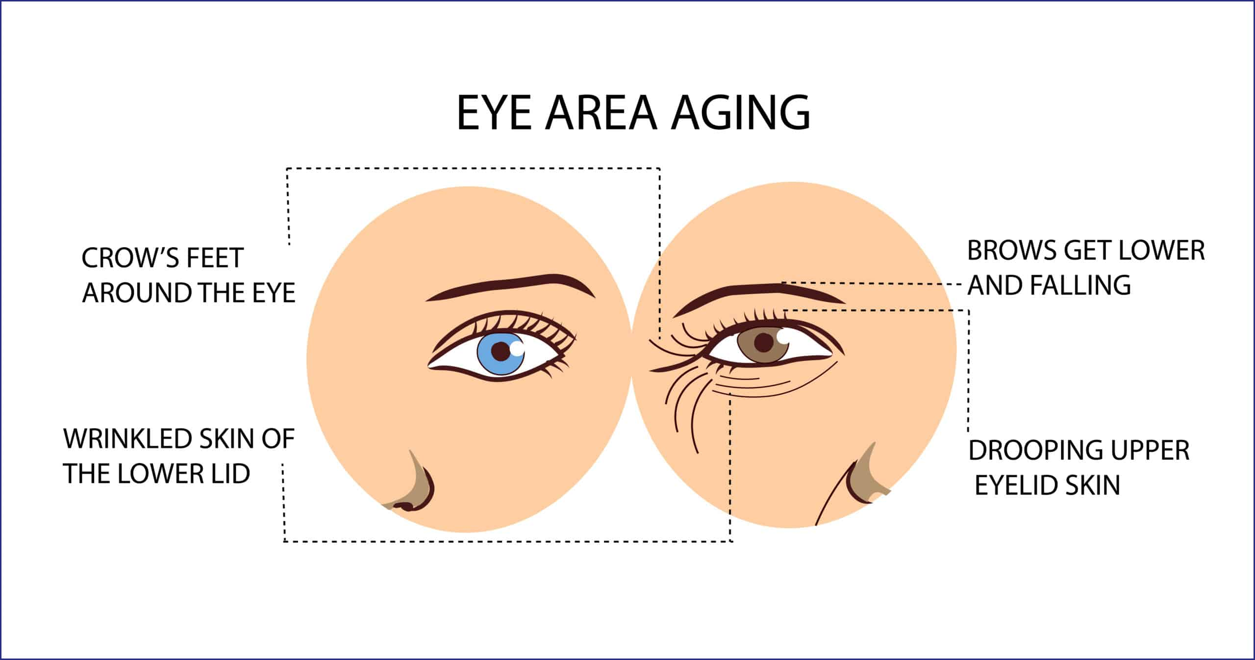 Concerns Affecting the Eyes