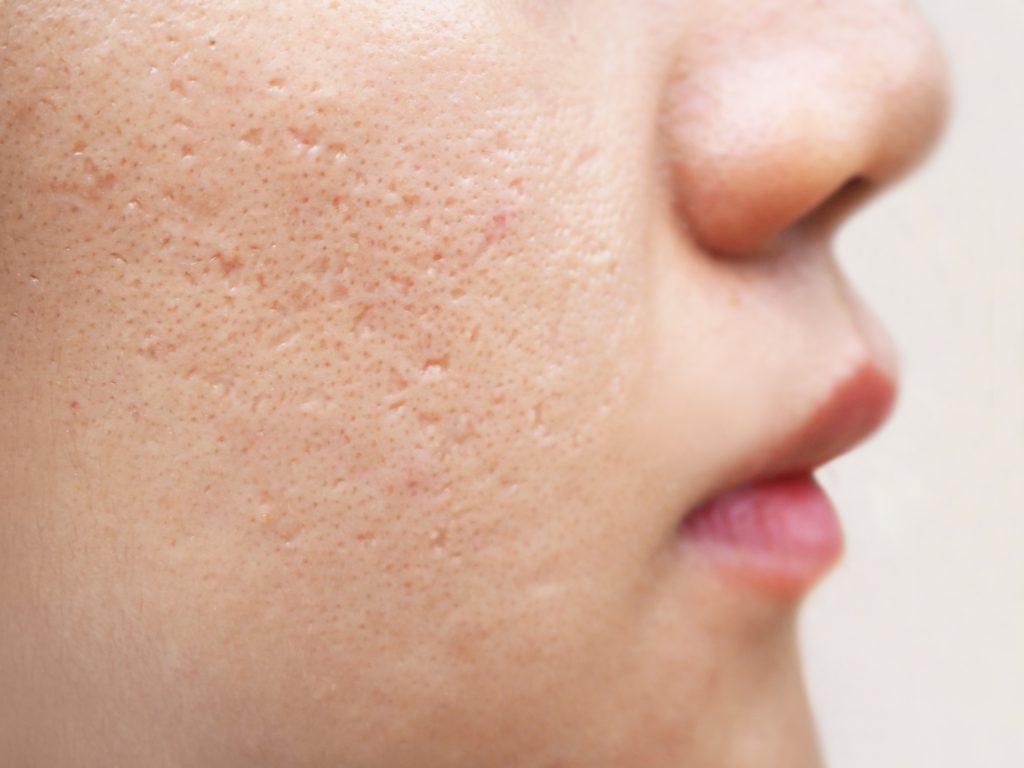 PRP for Acne Scars PRP Treatment for Acne Scars Bay Medical Aesthetics